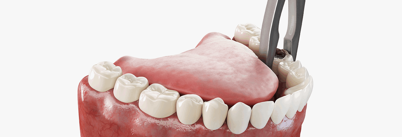 구강외과 주의사항